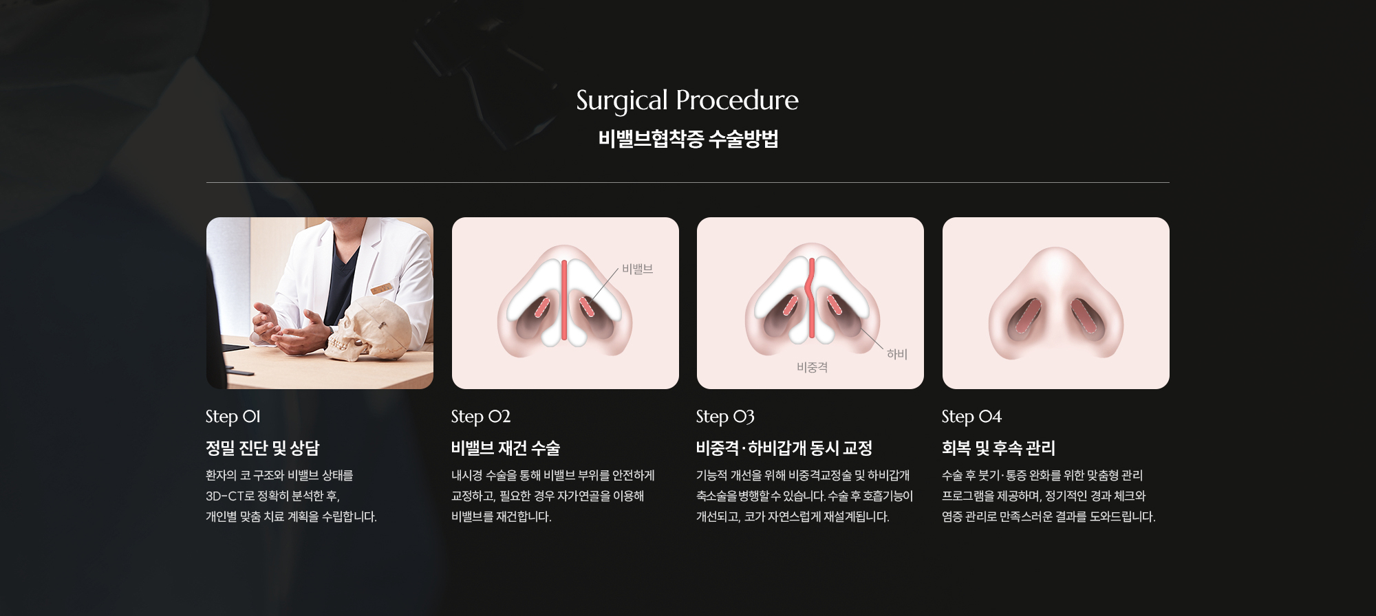 [비밸브협착증 수술방법] Step 01 : 정밀 진단 및 상담  /  Step 02 : 비밸브 재건 수술  /  Step 03 : 비중격·하비갑개 동시 교정  /  Step 04 : 회복 및 후속 관리