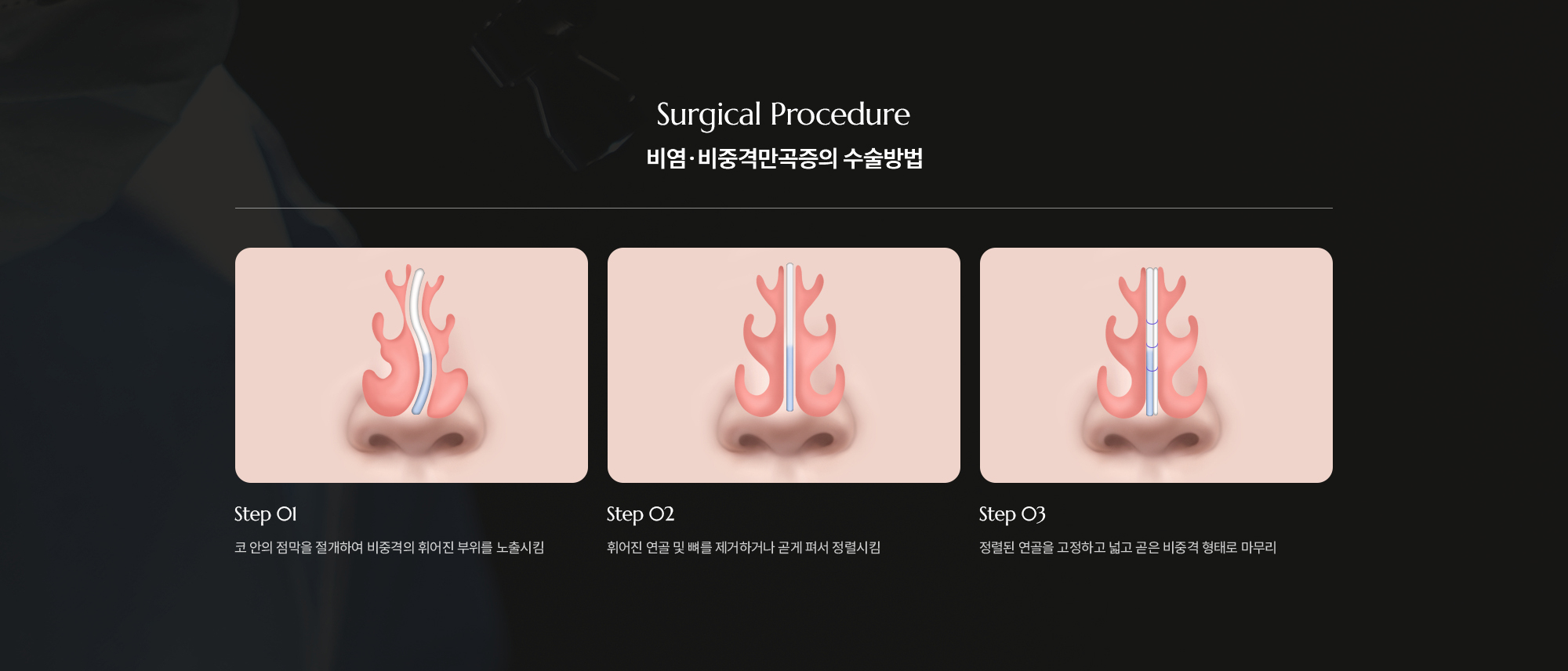[비염·비중격만곡증의 수술방법] Step 01 : 코 안의 점막을 절개하여 비중격의 휘어진 부위를 노출시킴  /  Step 02 : 휘어진 연골 및 뼈를 제거하거나 곧게 펴서 정렬시킴  /  Step 03 : 정렬된 연골을 고정하고 넓고 곧은 비중격 형태로 마무리