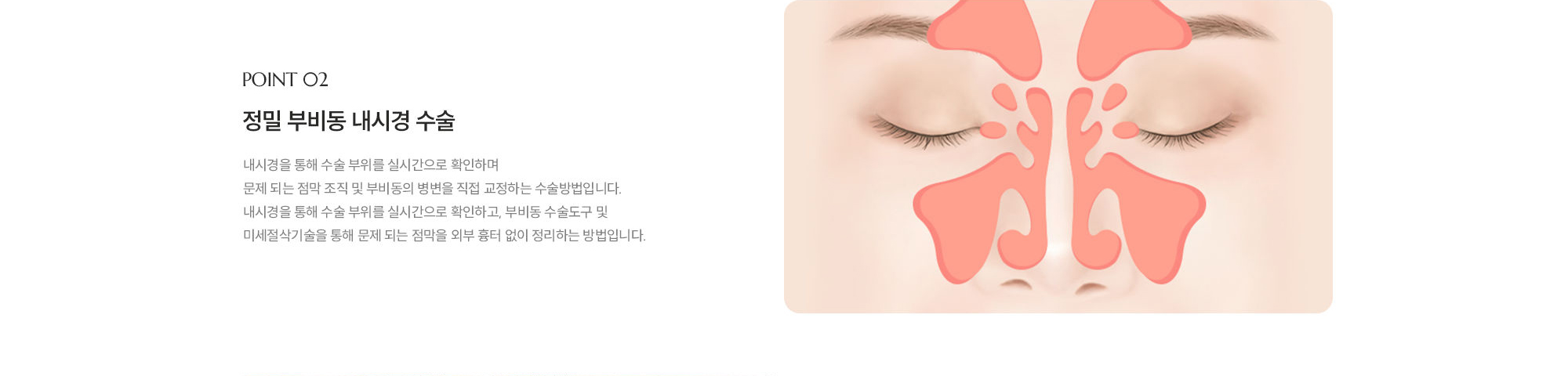 [POINT 02] 정밀 부비동 내시경 수술 : 내시경을 통해 수술 부위를 실시간으로 확인하며 문제 되는 점막 조직 및 부비동의 병변을 직접 교정하는 수술방법입니다. 내시경을 통해 수술 부위를 실시간으로 확인하고, 부비동 수술도구 및 미세절삭기술을 통해 문제 되는 점막을 외부 흉터 없이 정리하는 방법입니다.