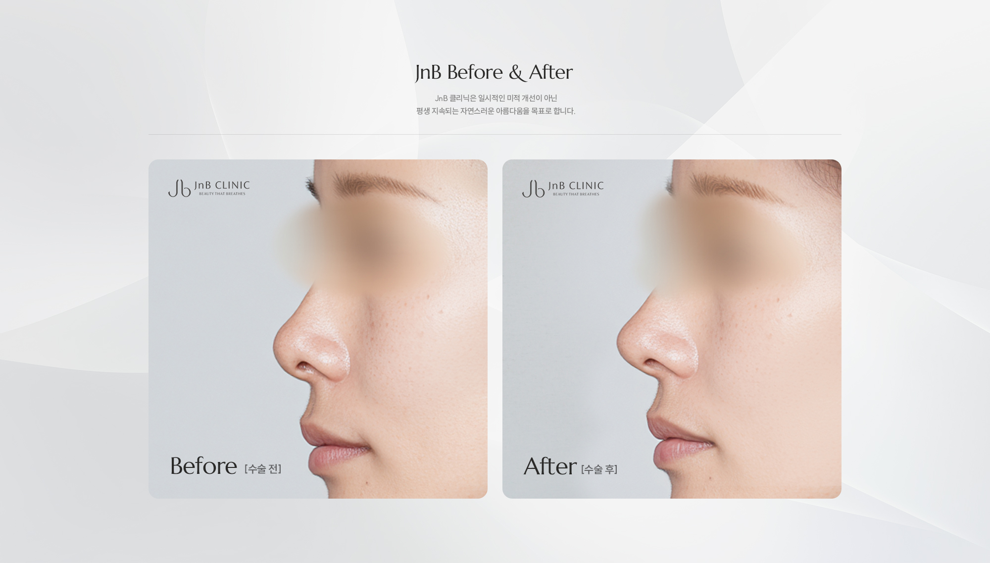 [JnB Before & After] JnB 클리닉은 일시적인 미적 개선이 아닌 평생 지속되는 자연스러운 아름다움을 목표로 합니다.