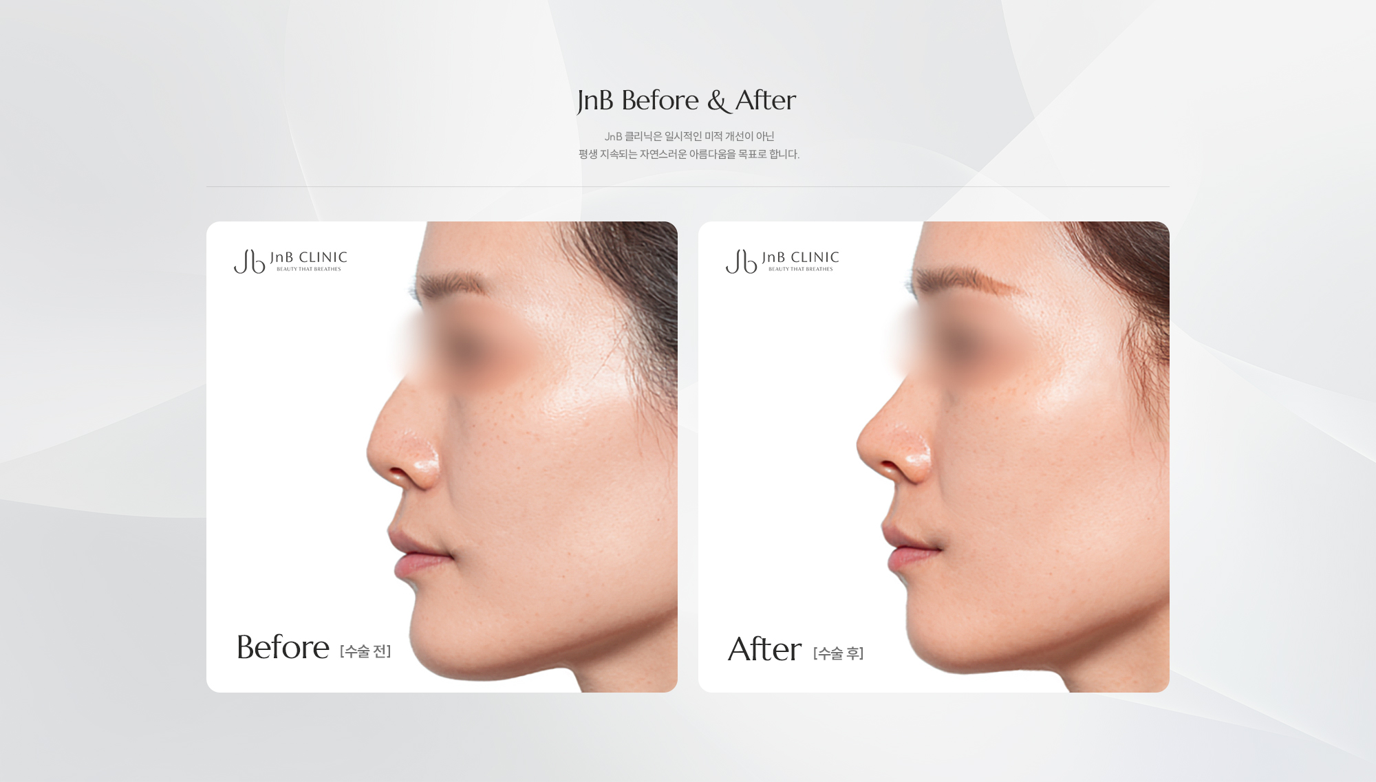 [JnB Before & After] JnB 클리닉은 일시적인 미적 개선이 아닌 평생 지속되는 자연스러운 아름다움을 목표로 합니다.