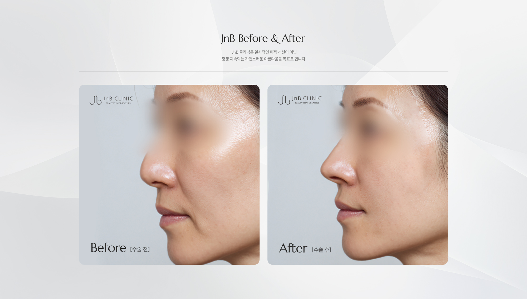 [JnB Before & After] JnB 클리닉은 일시적인 미적 개선이 아닌 평생 지속되는 자연스러운 아름다움을 목표로 합니다.