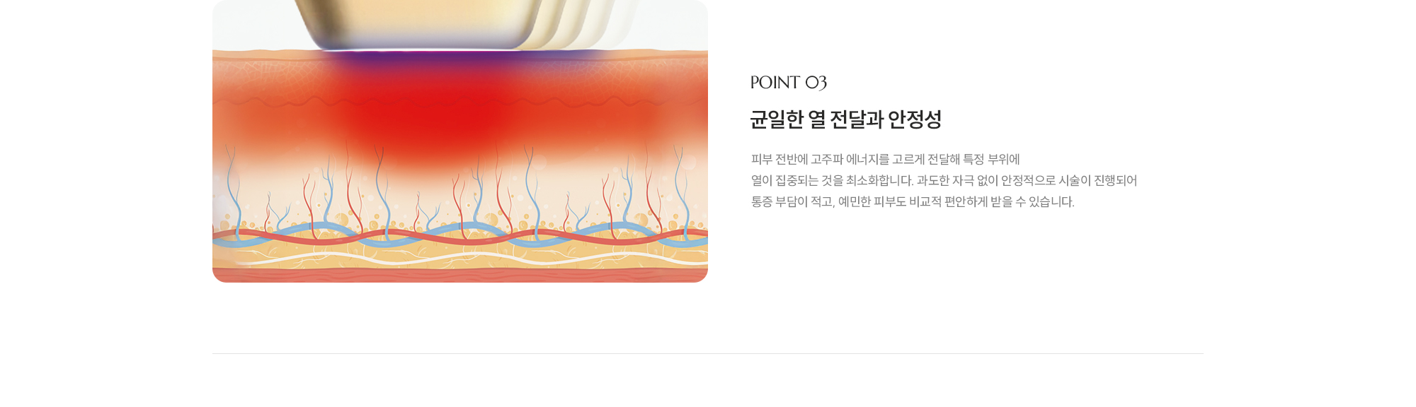 [POINT 03] [빠른 일상 복귀와 자연스러운 결과] 비침습적 시술로 피부 표면에 상처나 멍이 거의 남지 않아 시술 직후 바로 세안과 화장이 가능합니다. 인위적이지 않고 시간이 흐를수록 자연스럽게 예뻐지는 리프팅 효과로 만족도가 높습니다.