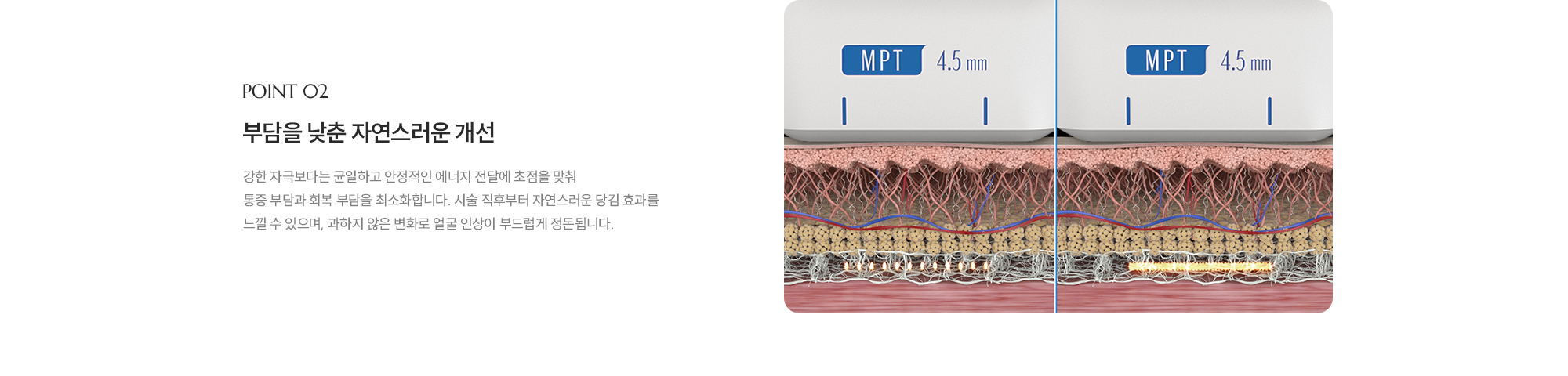[POINT 02] [부담을 낮춘 자연스러운 개선] 강한 자극보다는 균일하고 안정적인 에너지 전달에 초점을 맞춰 통증 부담과 회복 부담을 최소화합니다. 시술 직후부터 자연스러운 당김 효과를 느낄 수 있으며, 과하지 않은 변화로 얼굴 인상이 부드럽게 정돈됩니다.