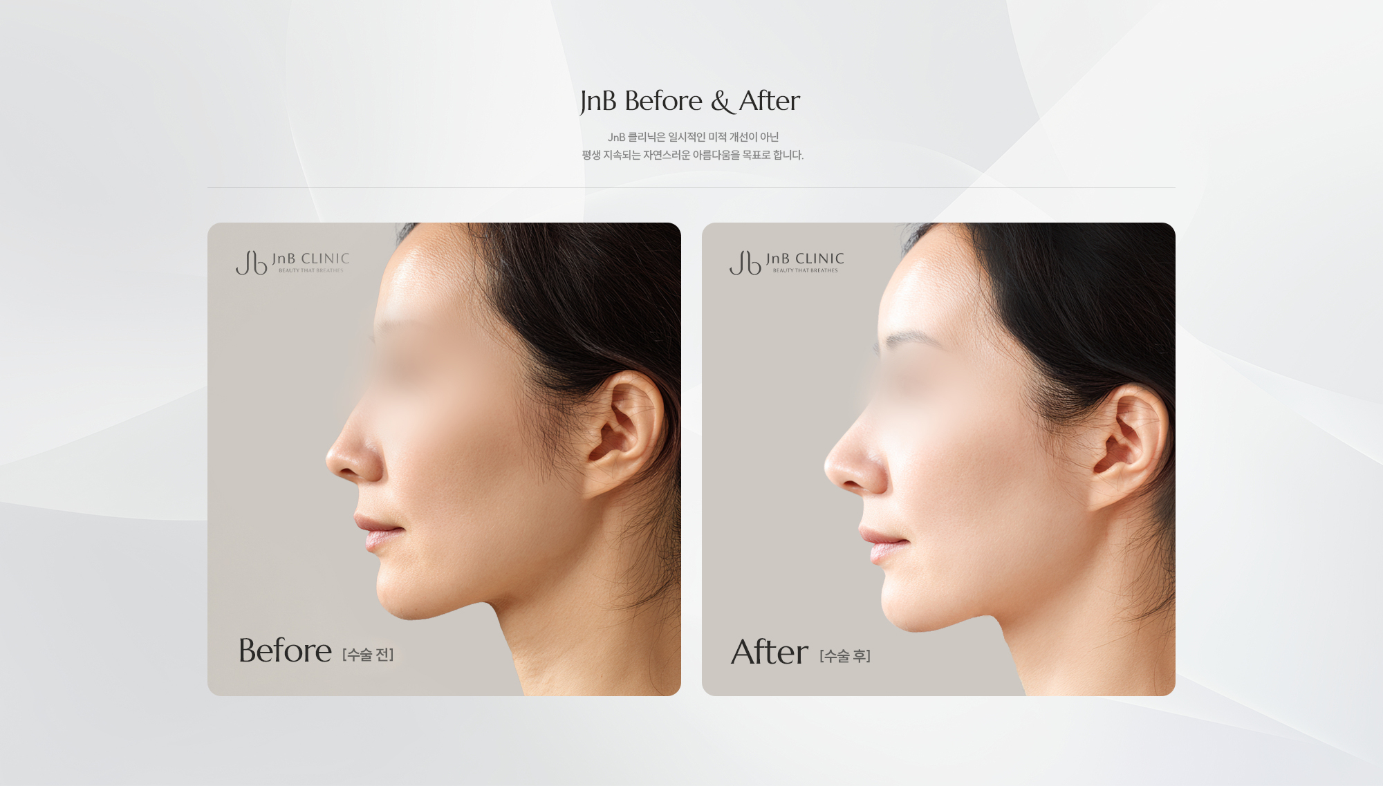[JnB Before & After] JnB 클리닉은 일시적인 미적 개선이 아닌 평생 지속되는 자연스러운 아름다움을 목표로 합니다.