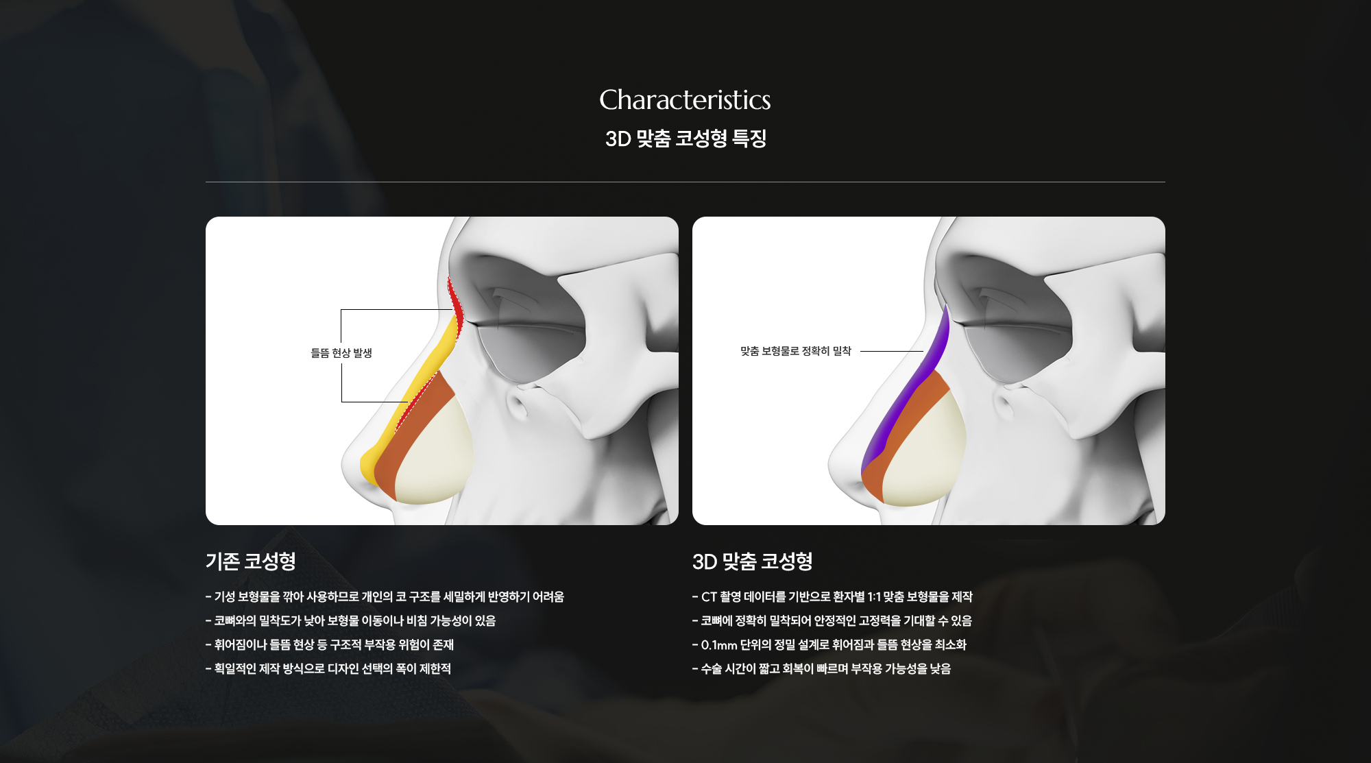 [3D 맞춤 코성형 특징] 기존 코성형 : - 기성 보형물을 깎아 사용하므로 개인의 코 구조를 세밀하게 반영하기 어려움 - 코뼈와의 밀착도가 낮아 보형물 이동이나 비침 가능성이 있음 - 휘어짐이나 들뜸 현상 등 구조적 부작용 위험이 존재 - 획일적인 제작 방식으로 디자인 선택의 폭이 제한적  /  3D 맞춤 코성형 :- CT 촬영 데이터를 기반으로 환자별 1:1 맞춤 보형물을 제작 - 코뼈에 정확히 밀착되어 안정적인 고정력을 기대할 수 있음  - 0.1mm 단위의 정밀 설계로 휘어짐과 들뜸 현상을 최소화 - 수술 시간이 짧고 회복이 빠르며 부작용 가능성을 낮음 