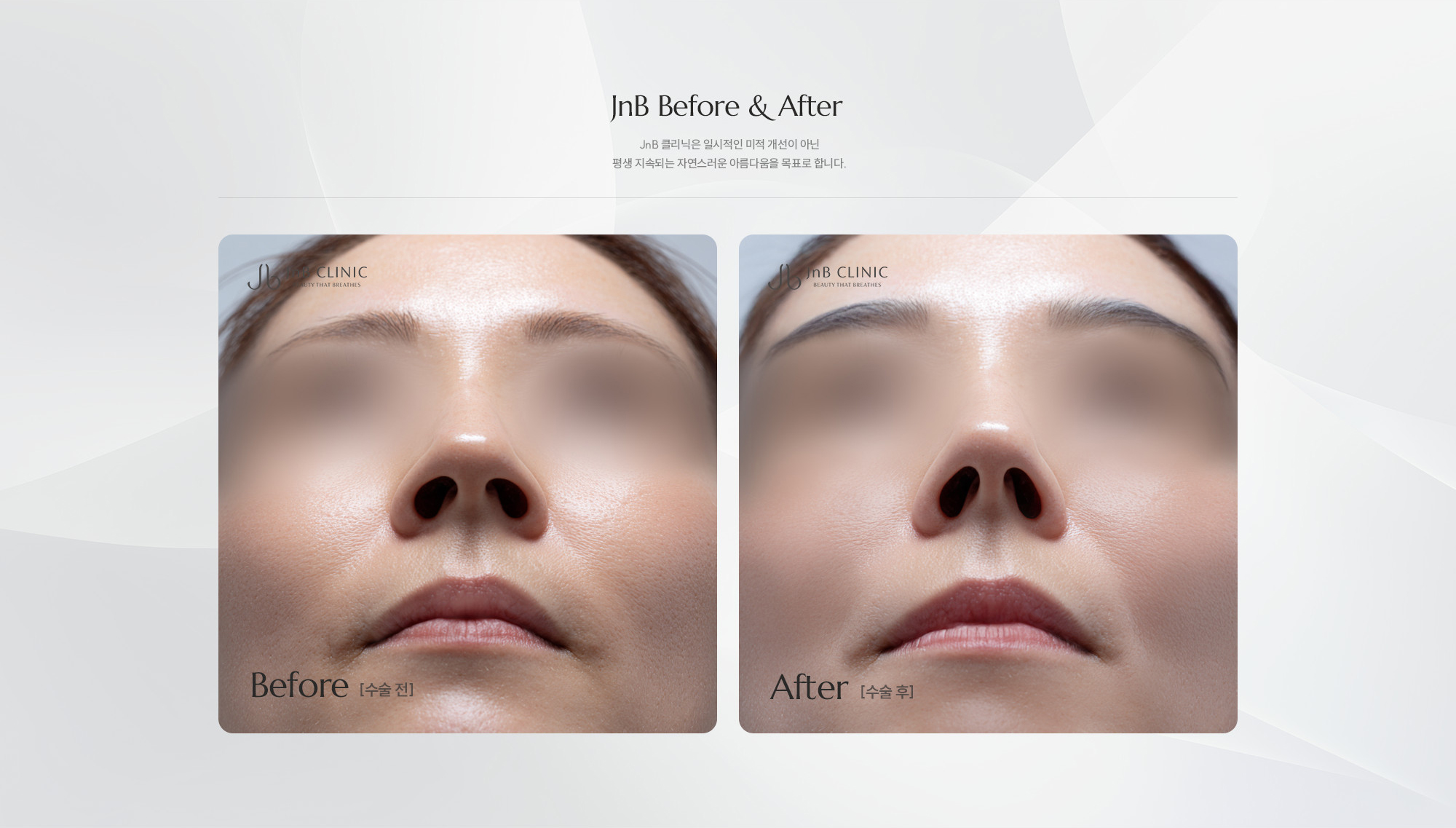 [JnB Before & After] JnB 클리닉은 일시적인 미적 개선이 아닌 평생 지속되는 자연스러운 아름다움을 목표로 합니다.