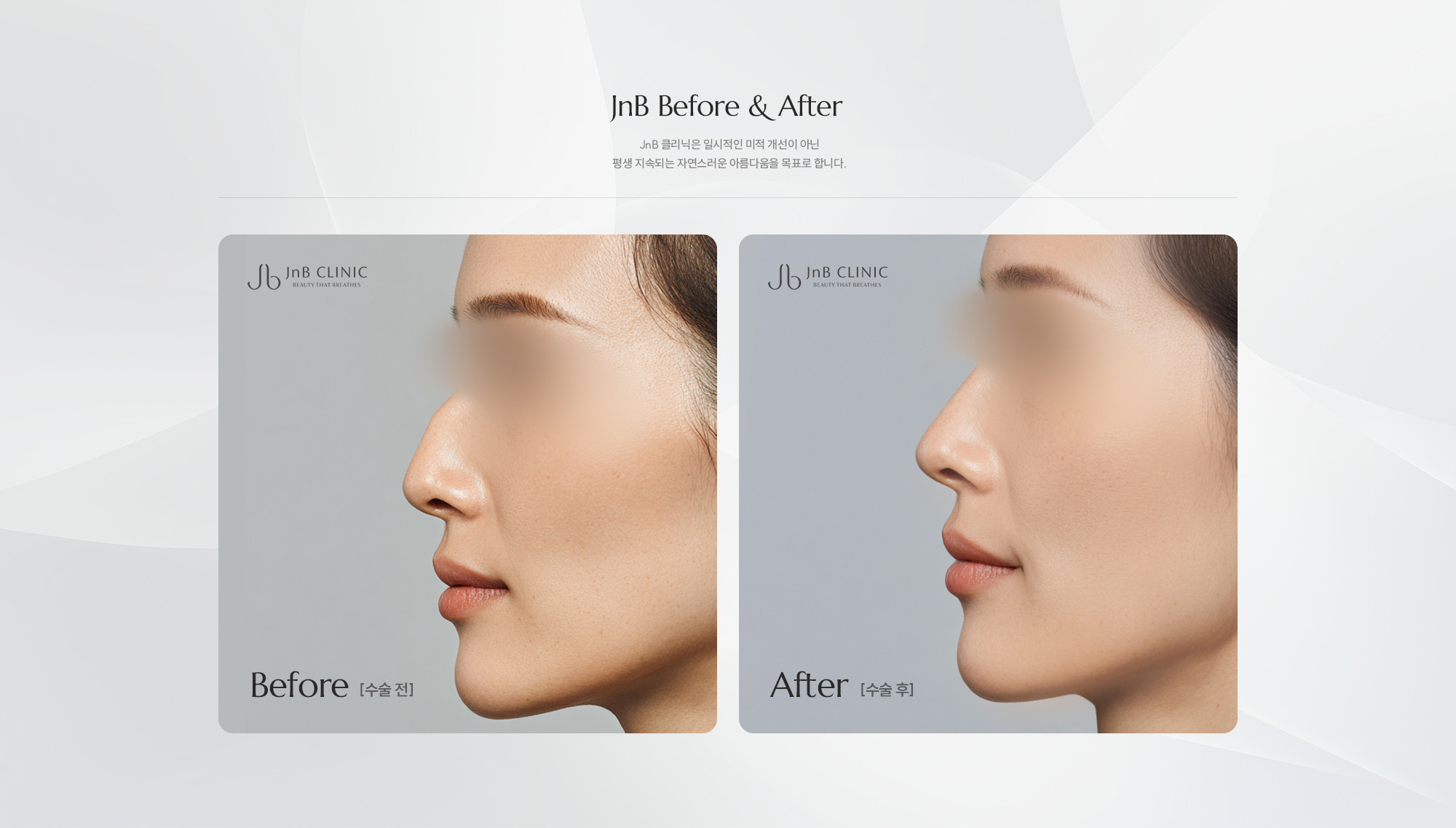 [JnB Before & After] JnB 클리닉은 일시적인 미적 개선이 아닌 평생 지속되는 자연스러운 아름다움을 목표로 합니다.