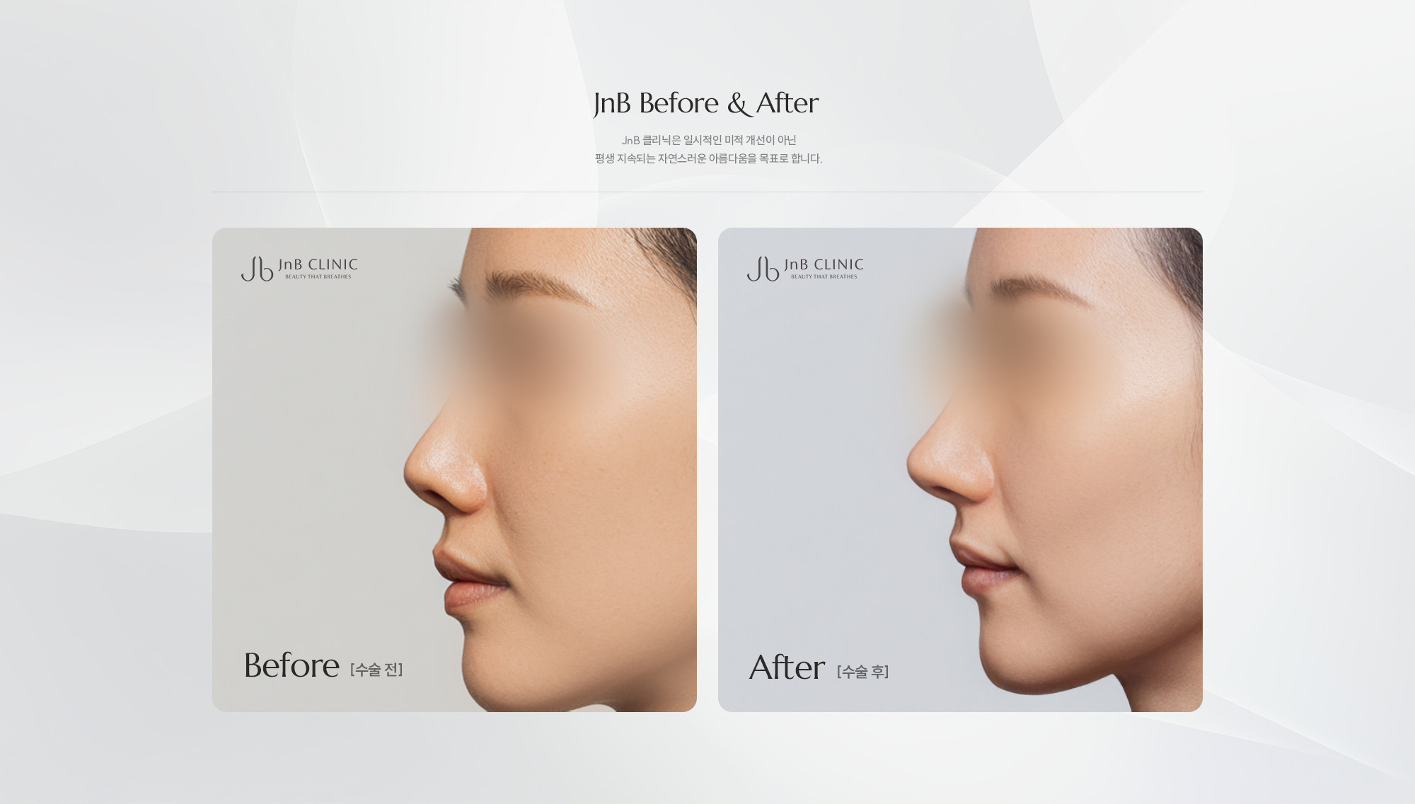 [JnB Before & After] JnB 클리닉은 일시적인 미적 개선이 아닌 평생 지속되는 자연스러운 아름다움을 목표로 합니다.