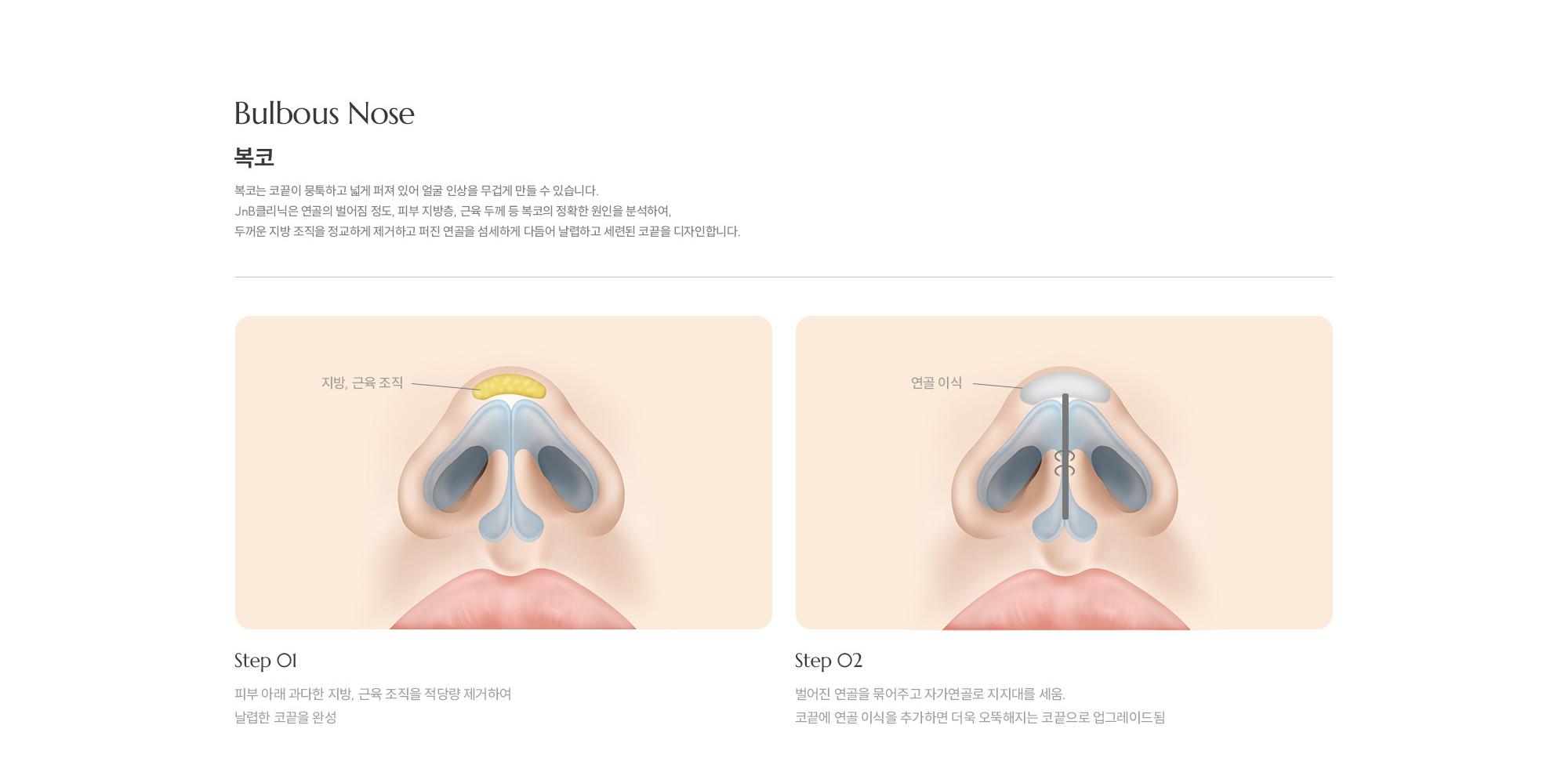 [복코] 복코는 코끝이 뭉툭하고 넓게 퍼져 있어 얼굴 인상을 무겁게 만들 수 있습니다. JnB클리닉은 연골의 벌어짐 정도, 피부 지방층, 근육 두께 등 복코의 정확한 원인을 분석하여, 두꺼운 지방 조직을 정교하게 제거하고 퍼진 연골을 섬세하게 다듬어 날렵하고 세련된 코끝을 디자인합니다.