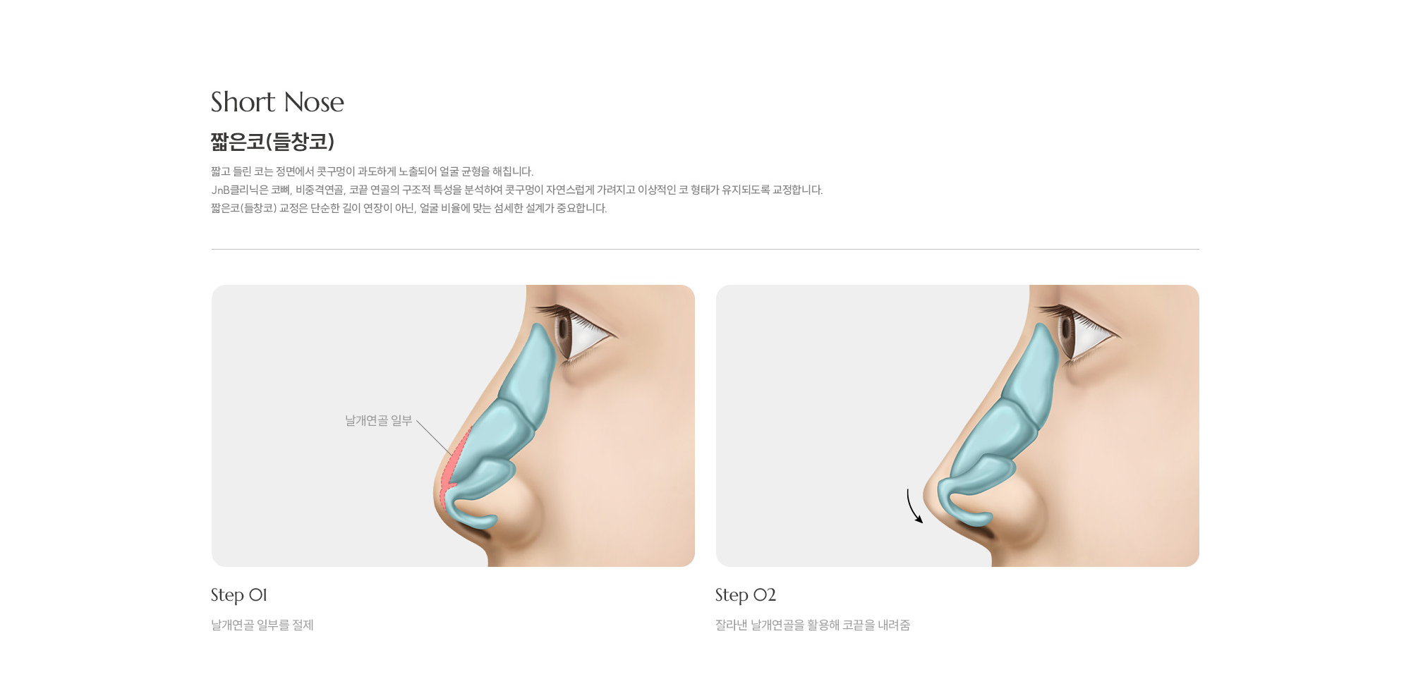 [짧은코(들창코)] 짧고 들린 코는 정면에서 콧구멍이 과도하게 노출되어 얼굴 균형을 해칩니다. JnB클리닉은 코뼈, 비중격연골, 코끝 연골의 구조적 특성을 분석하여 콧구멍이 자연스럽게 가려지고 이상적인 코 형태가 유지되도록 교정합니다. 짧은코(들창코) 교정은 단순한 길이 연장이 아닌, 얼굴 비율에 맞는 섬세한 설계가 중요합니다.