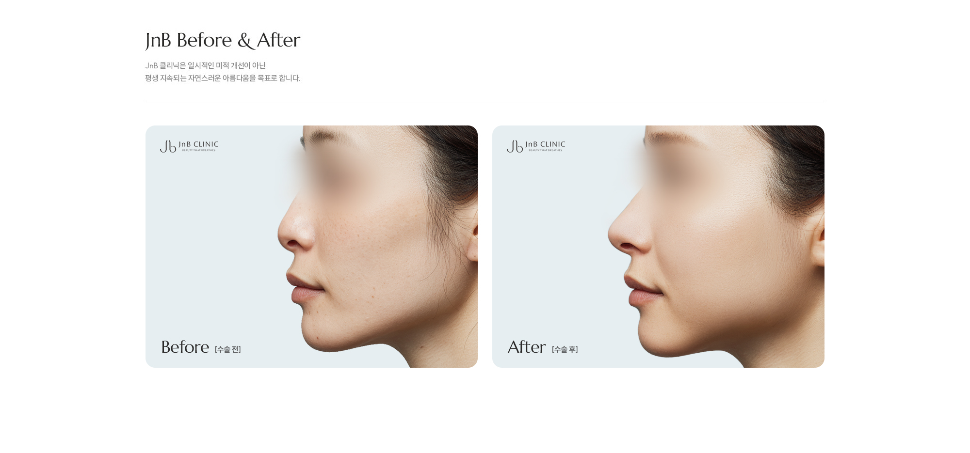 [짧은코(들창코) 수술방법] Step 01 : 날개연골 일부를 절제 / Step 02 : 잘라낸 날개연골을 활용해 코끝을 내려줌