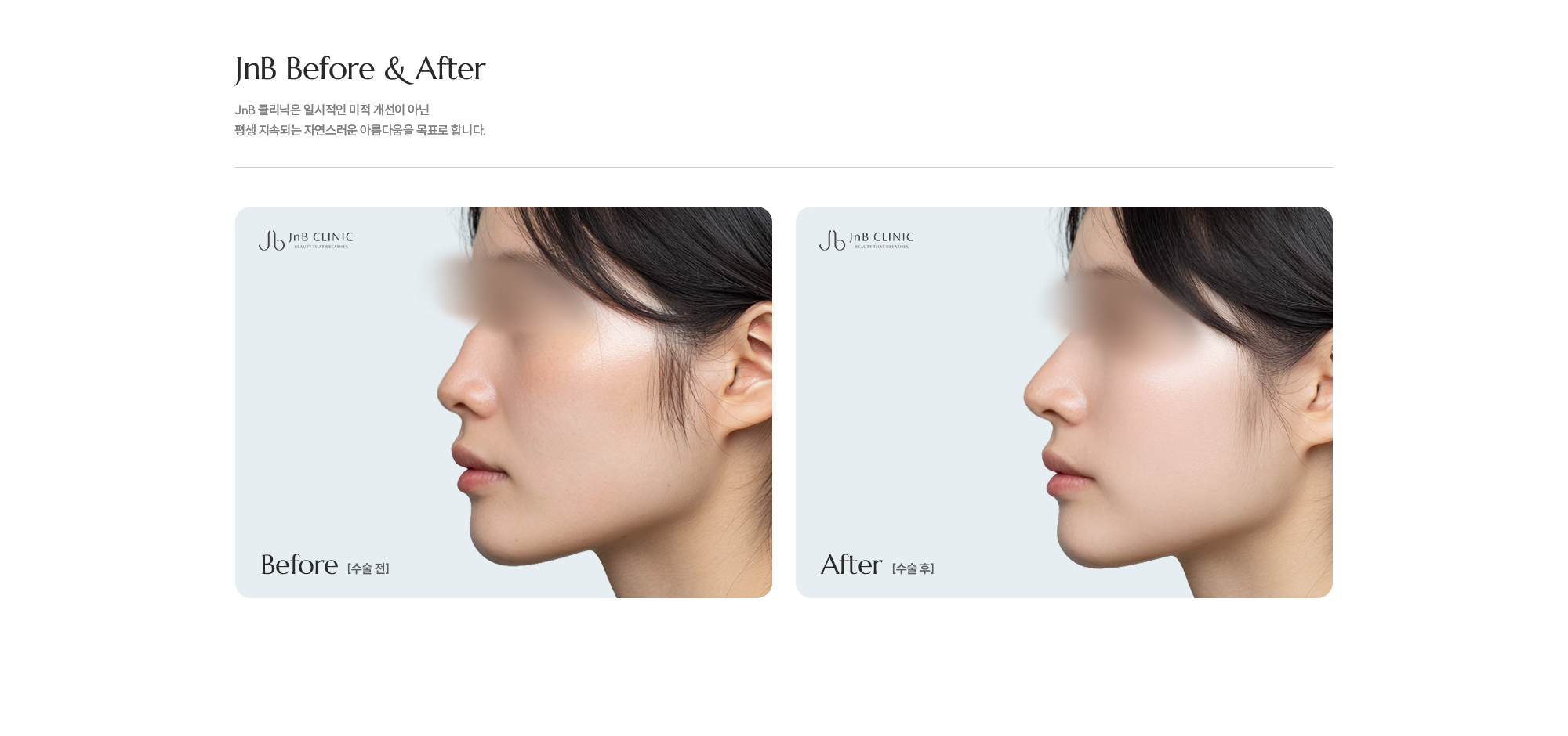 [매부리코 수술방법] Step 01 : 튀어나온 매부리 부위를 갈거나 절골하여 개선 / Step 02 : 매끈한 콧대와 코끝으로 부드럽고 세련된 인상