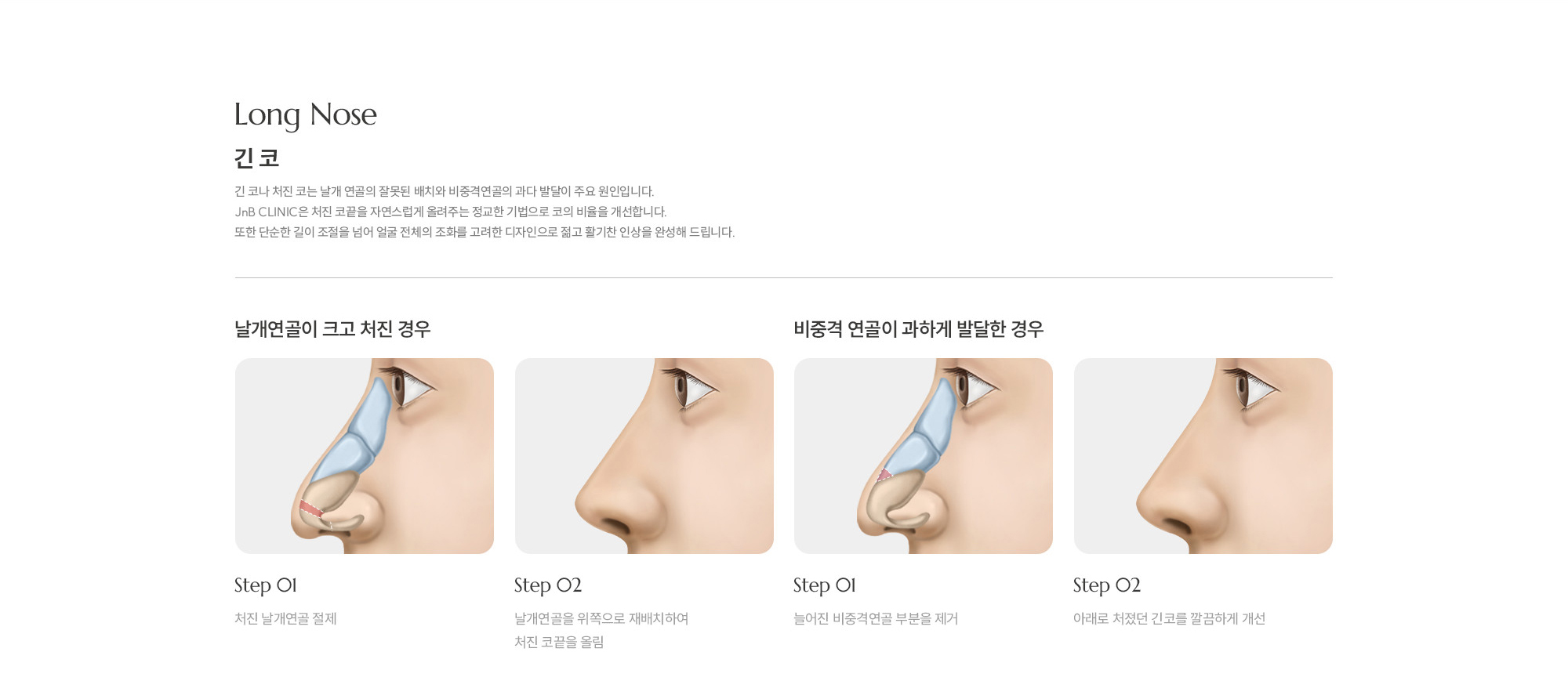 [긴 코] 긴 코나 처진 코는 날개 연골의 잘못된 배치와 비중격연골의 과다 발달이 주요 원인입니다. JnB CLINIC은 처진 코끝을 자연스럽게 올려주는 정교한 기법으로 코의 비율을 개선합니다. 또한 단순한 길이 조절을 넘어 얼굴 전체의 조화를 고려한 디자인으로 젊고 활기찬 인상을 완성해 드립니다. 