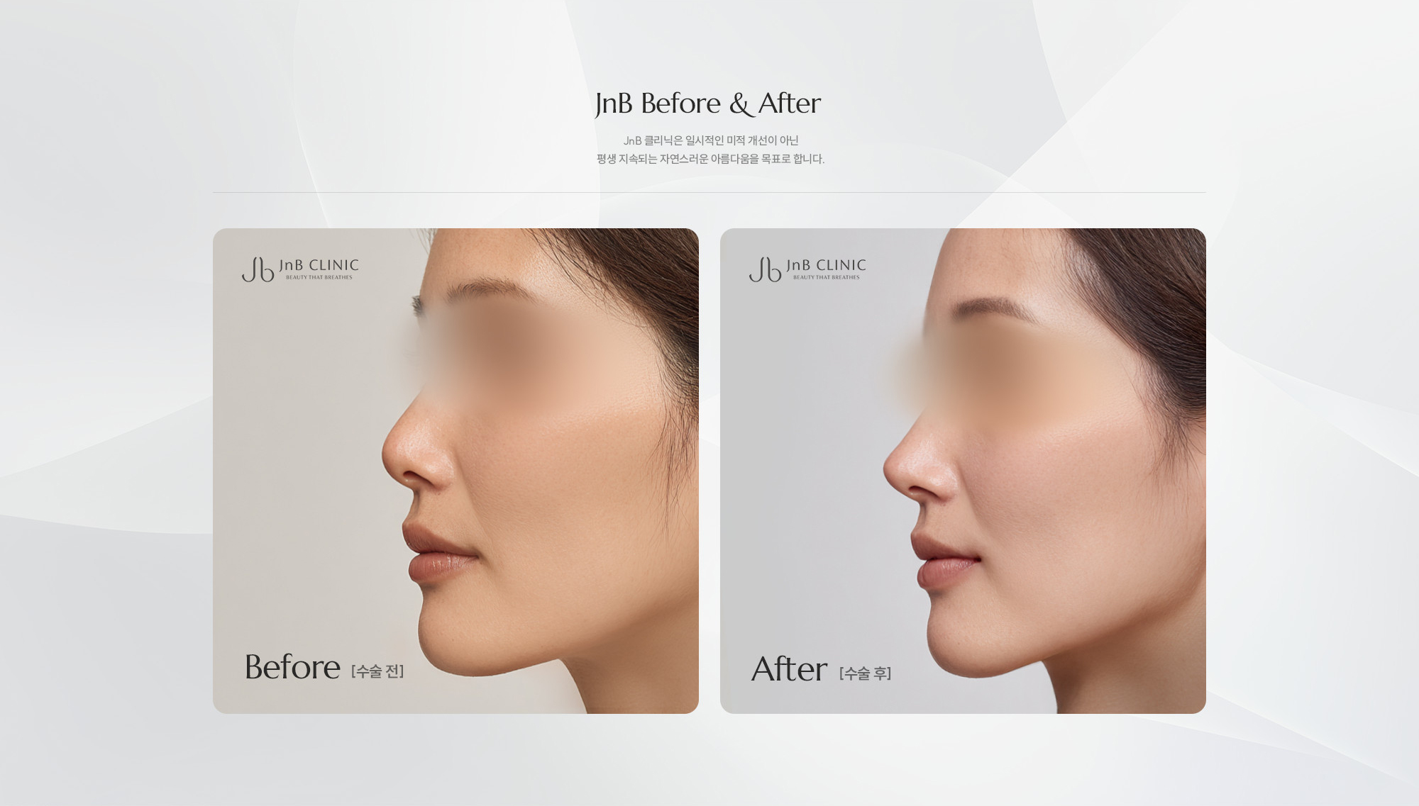 [JnB Before & After] JnB 클리닉은 일시적인 미적 개선이 아닌 평생 지속되는 자연스러운 아름다움을 목표로 합니다.