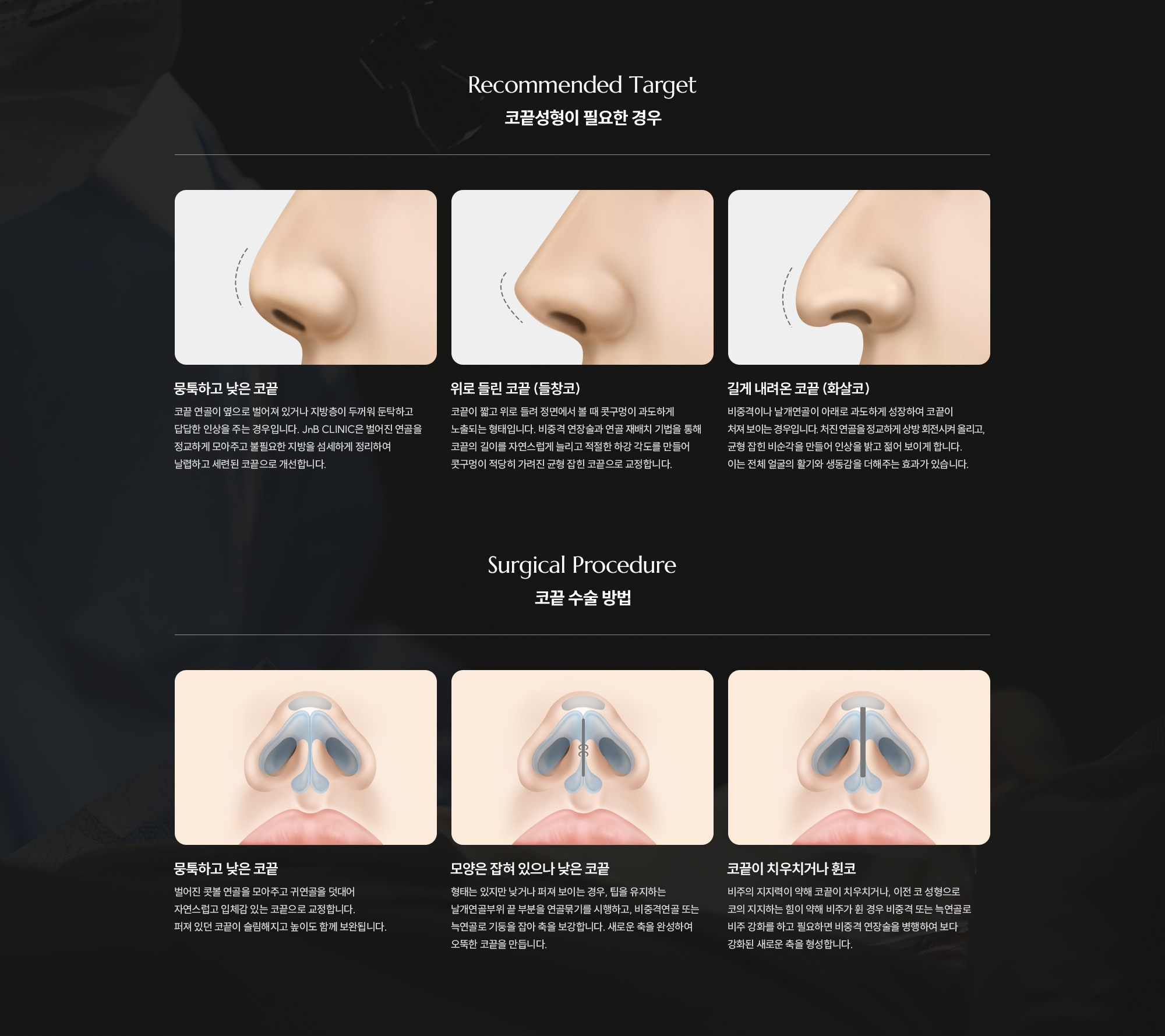 [코끝성형이 필요한 경우] 뭉툭하고 낮은 코끝  /  위로 들린 코끝 (들창코)  /  길게 내려온 코끝 (화살코) [코끝 수술 방법] 뭉툭하고 낮은 코끝  /  모양은 잡혀 있으나 낮은 코끝  /  코끝이 치우치거나 휜코